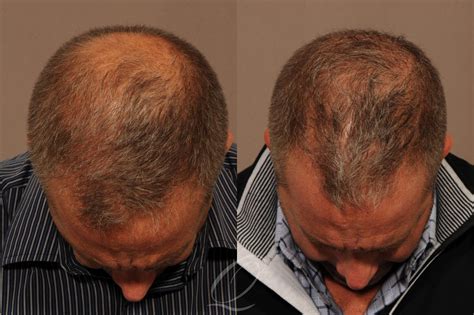 Hair Restoration Surgery Near Me .